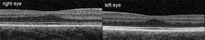 Spontaneous Nystagmus in the Dark in an Infantile Nystagmus Patient May Represent Negative Optokinetic Afternystagmus